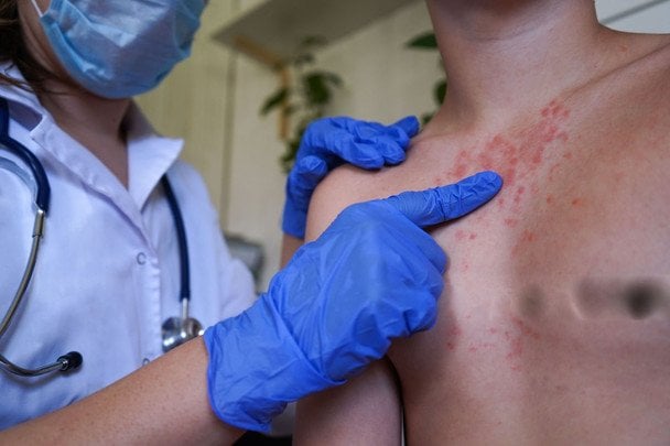 Зафіксовано спалах кору серед школярів, вже 60 дітей захворіли