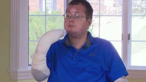 Чоловік із "синдромом метелика" розповів про життя з рідкісною хворобою