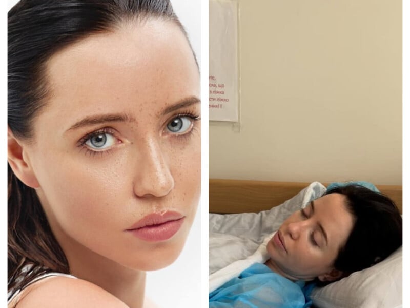 "Це катастрофа". Шрам на грудях і хвороба, яка ледь не понівечила обличчя – що роками приховувала Дорофєєва