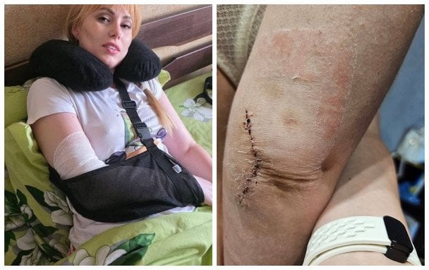 Вийшла з ТЦК з інвалідністю: резонансна справа побитої адвокатки дійшла до ЄСПЛ (фото)